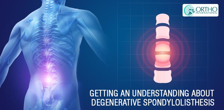 Getting An Understanding About Degenerative Spondylolisthesis