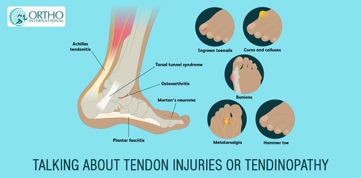 Talking About Tendon Injuries Or Tendinopathy