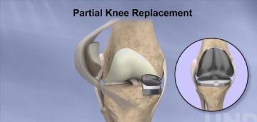 Arthroscopy Surgery