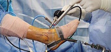 Arthroscopy Surgery