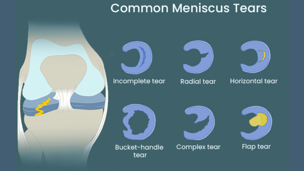 Symptoms of Torn meniscus?